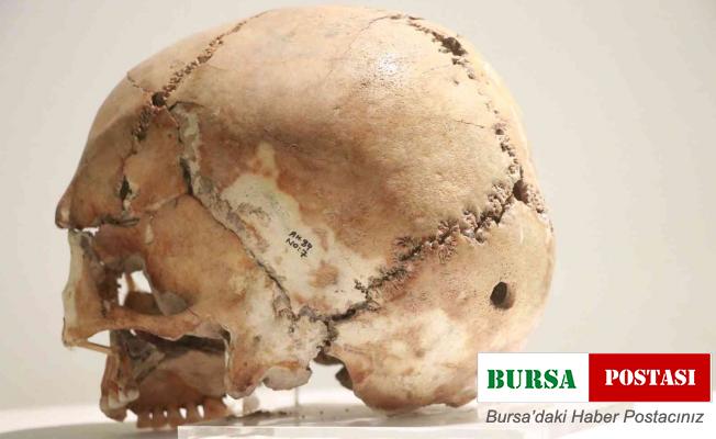 Dünyanın ilk beyin ameliyatı 10 bin 500 yıl önce Aksaray’da yapıldı