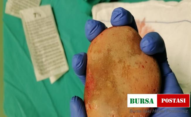 Mesaneden çıkan taş doktorları şaşırttı